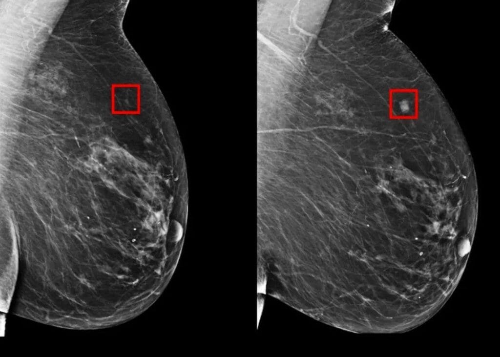 Cáncer de mama Inteligencia artificial